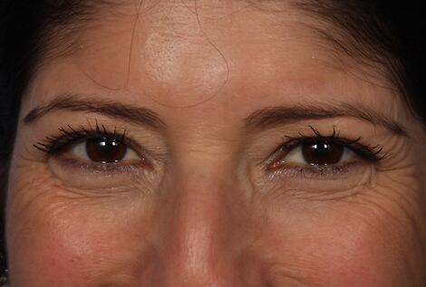 BOTOX® Cosmetic Before & After Image