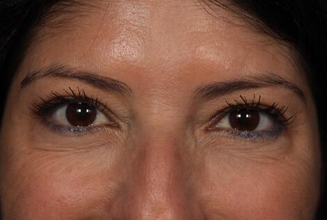 BOTOX® Cosmetic Before & After Image