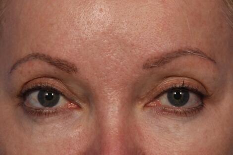 BOTOX® Cosmetic Before & After Image