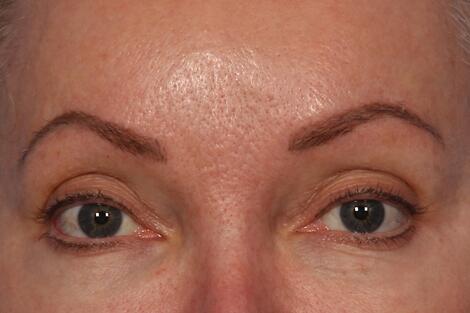 BOTOX® Cosmetic Before & After Image