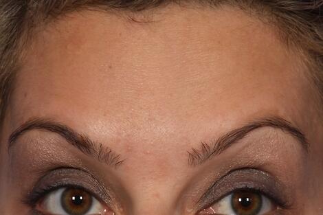 BOTOX® Cosmetic Before & After Image