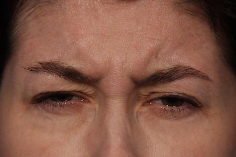 BOTOX® Cosmetic Before & After Image