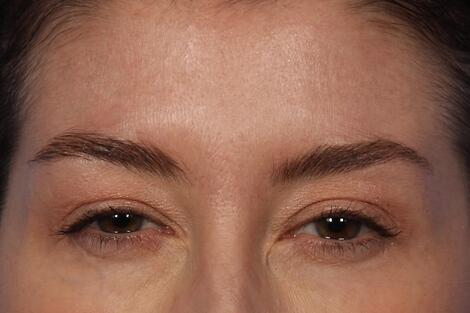 BOTOX® Cosmetic Before & After Image