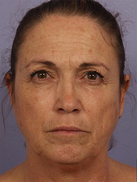 BOTOX® Cosmetic Before & After Image