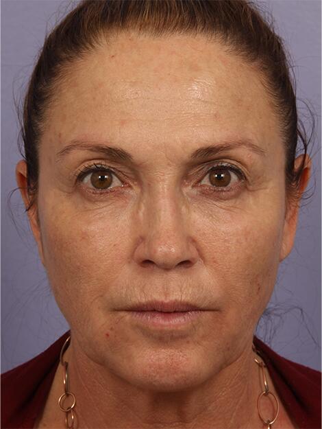 BOTOX® Cosmetic Before & After Image