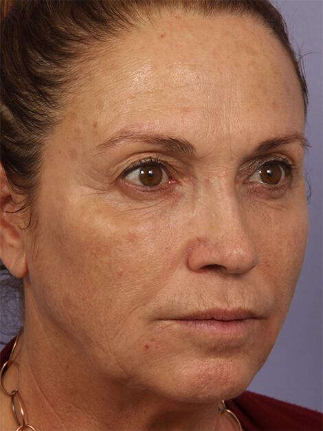 BOTOX® Cosmetic Before & After Image