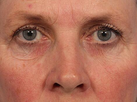 BOTOX® Cosmetic Before & After Image