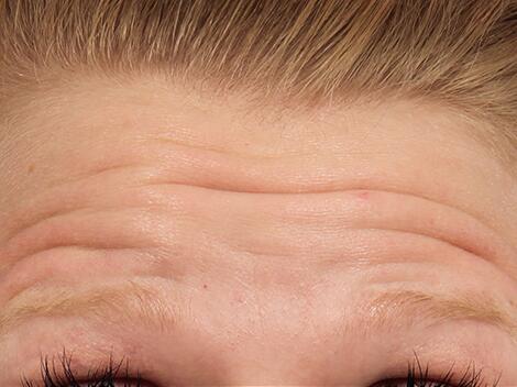 BOTOX® Cosmetic Before & After Image