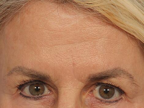 BOTOX® Cosmetic Before & After Image