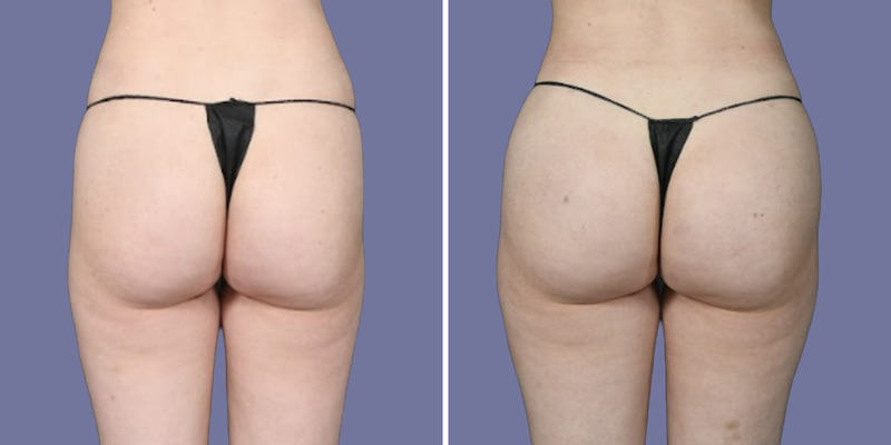 Brazilian Butt Lift Before & After Image