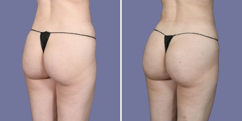 Brazilian Butt Lift Before & After Image