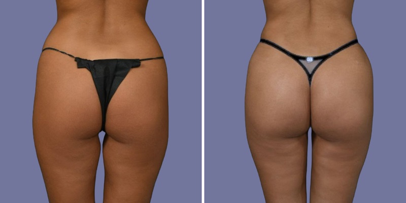Brazilian Butt Lift Before & After Image