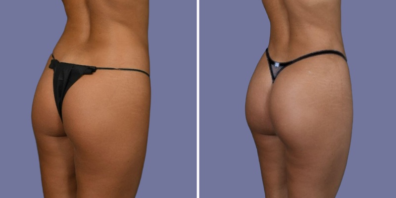 Brazilian Butt Lift Before & After Image