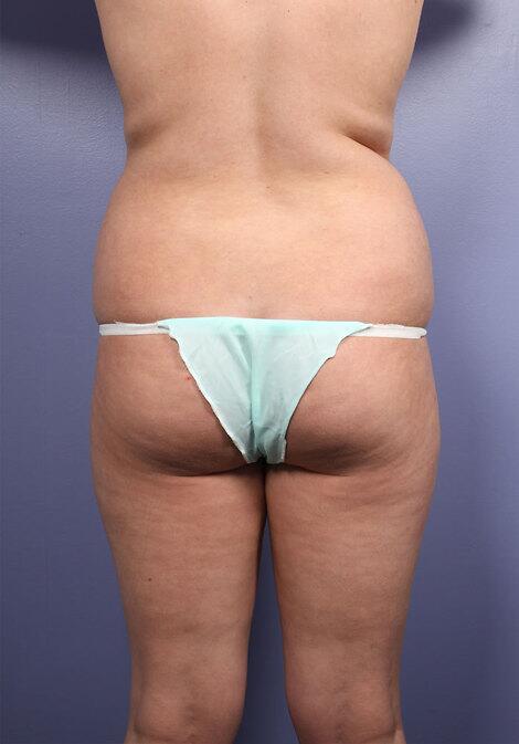 Brazilian Butt Lift Before & After Image