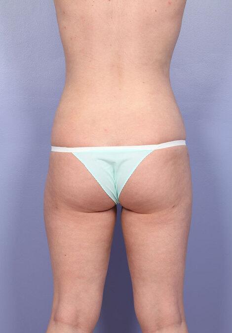 Brazilian Butt Lift Before & After Image