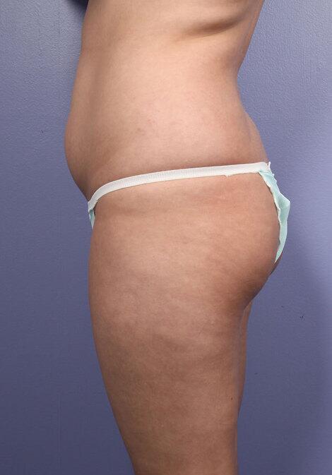 Brazilian Butt Lift Before & After Image