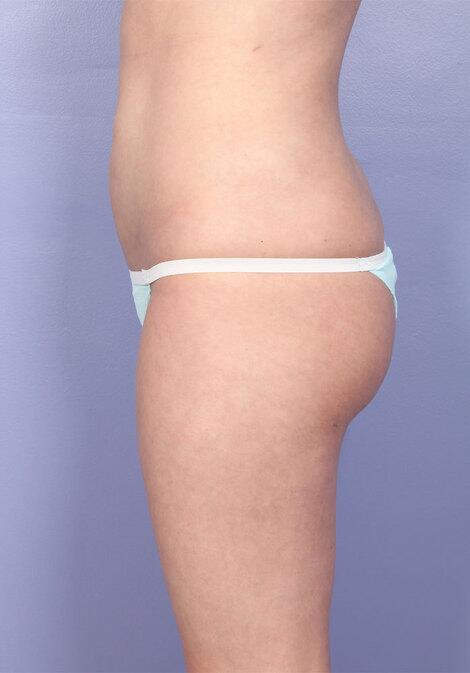 Brazilian Butt Lift Before & After Image