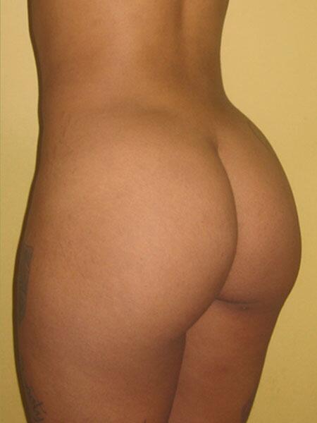 Brazilian Butt Lift Before & After Image