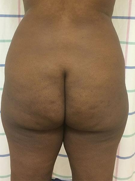 Brazilian Butt Lift Before & After Image