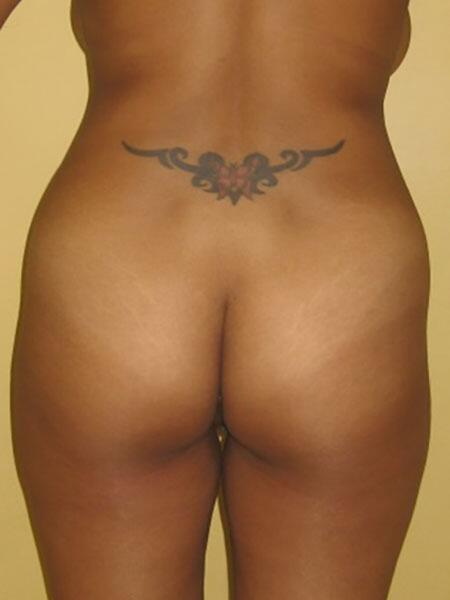 Brazilian Butt Lift Before & After Image