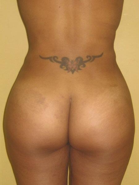 Brazilian Butt Lift Before & After Image