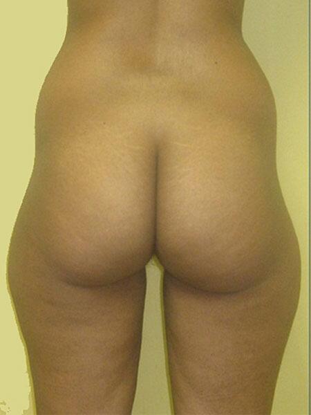 Brazilian Butt Lift Before & After Image