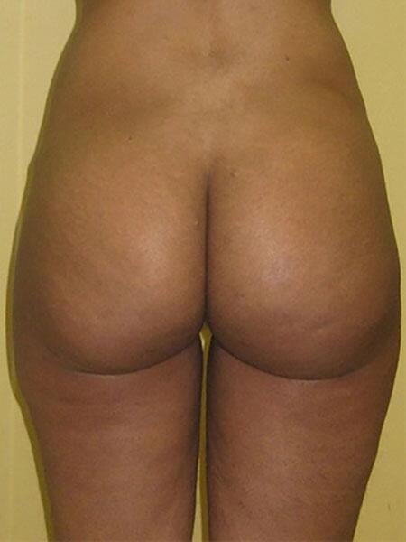 Brazilian Butt Lift Before & After Image