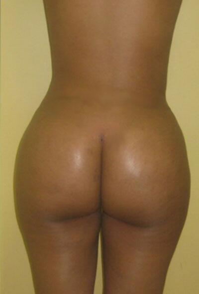 Brazilian Butt Lift Before & After Image