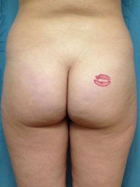 Brazilian Butt Lift Before & After Image