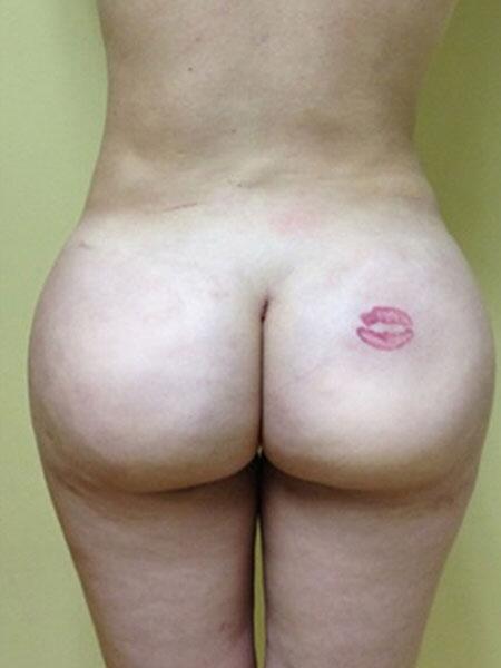 Brazilian Butt Lift Before & After Image