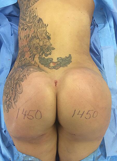 Brazilian Butt Lift Before & After Image