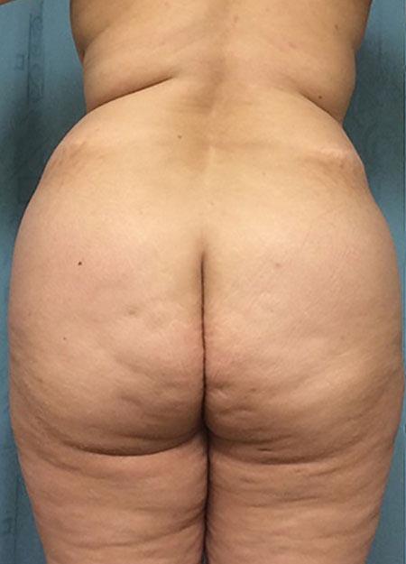 Brazilian Butt Lift Before & After Image