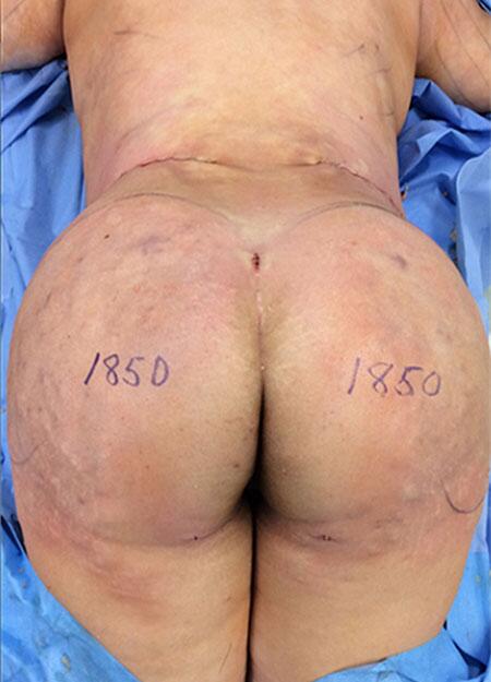 Brazilian Butt Lift Before & After Image