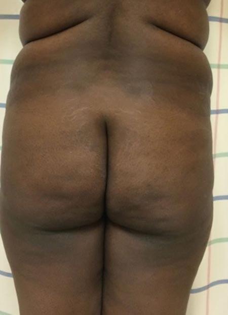 Brazilian Butt Lift Before & After Image