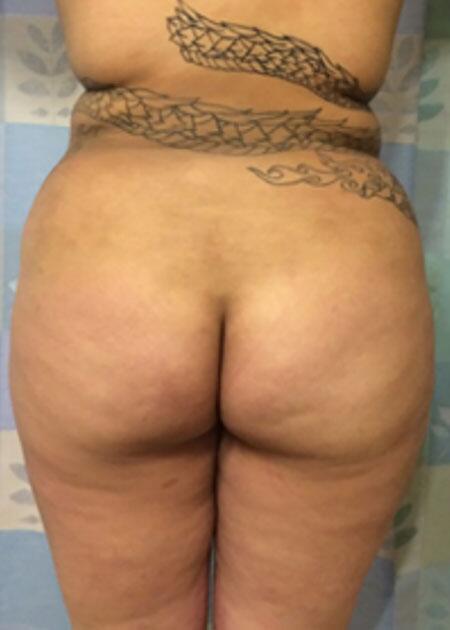 Brazilian Butt Lift Before & After Image