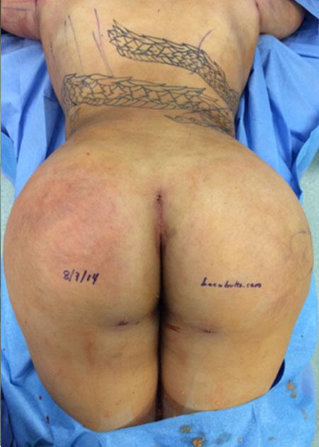 Brazilian Butt Lift Before & After Image