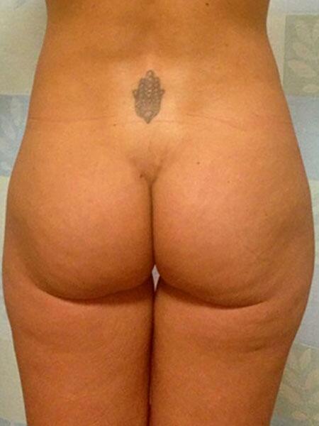 Brazilian Butt Lift Before & After Image