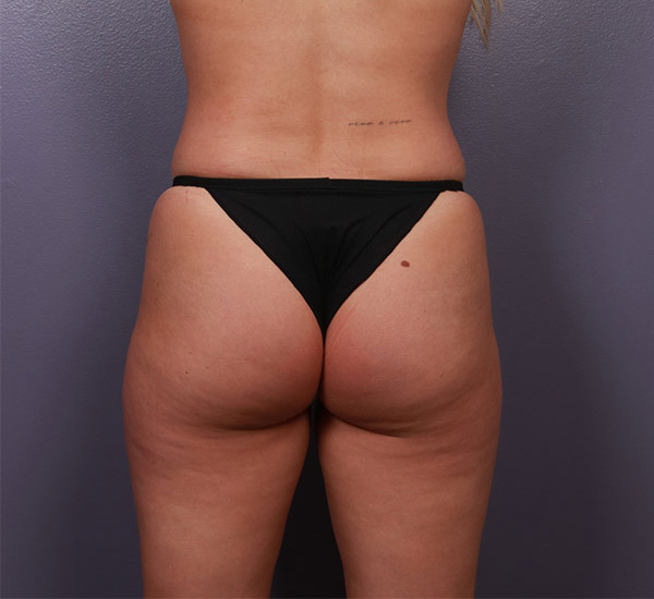 Brazilian Butt Lift Before & After Image