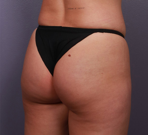 Brazilian Butt Lift Before & After Image