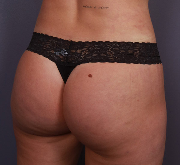 Brazilian Butt Lift Before & After Image