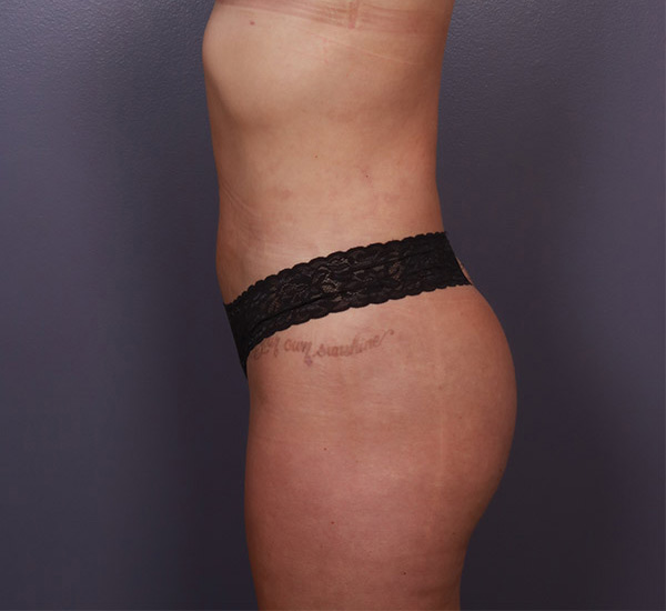 Brazilian Butt Lift Before & After Image