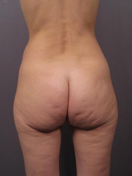 Brazilian Butt Lift Before & After Image