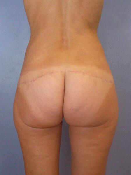 Brazilian Butt Lift Before & After Image