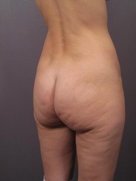 Brazilian Butt Lift Before & After Image