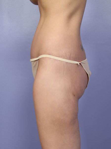 Brazilian Butt Lift Before & After Image