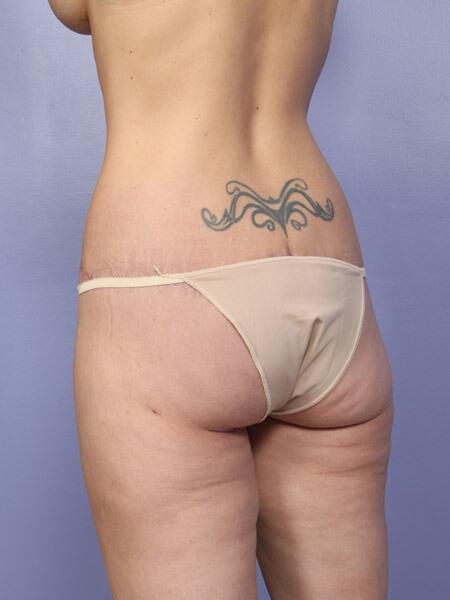 Brazilian Butt Lift Before & After Image