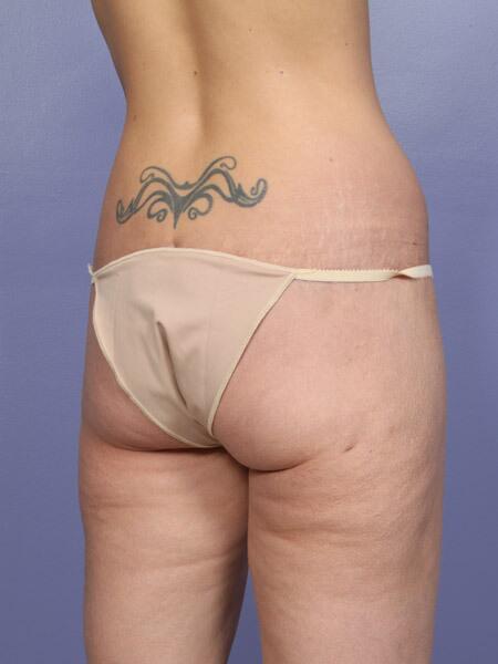 Brazilian Butt Lift Before & After Image