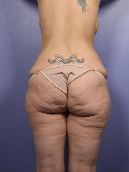 Brazilian Butt Lift Before & After Image