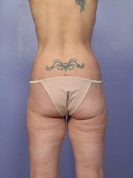 Brazilian Butt Lift Before & After Image