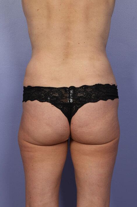 Brazilian Butt Lift Before & After Image